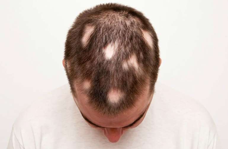 alopecia men hair loss