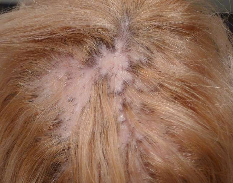 cicatrical alopecia for men