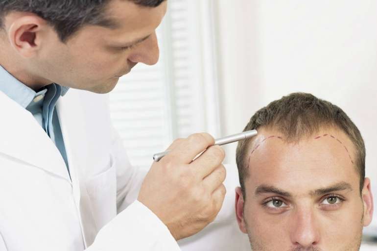hair loss alopecia men treatments