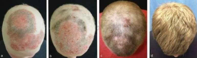 jak inhibitor alopecia tofacitinib citrate cream