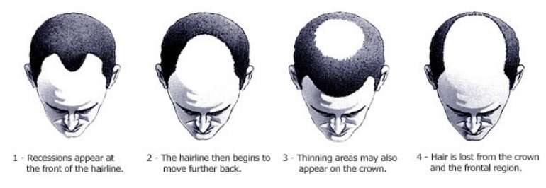 male pattern baldness hair loss