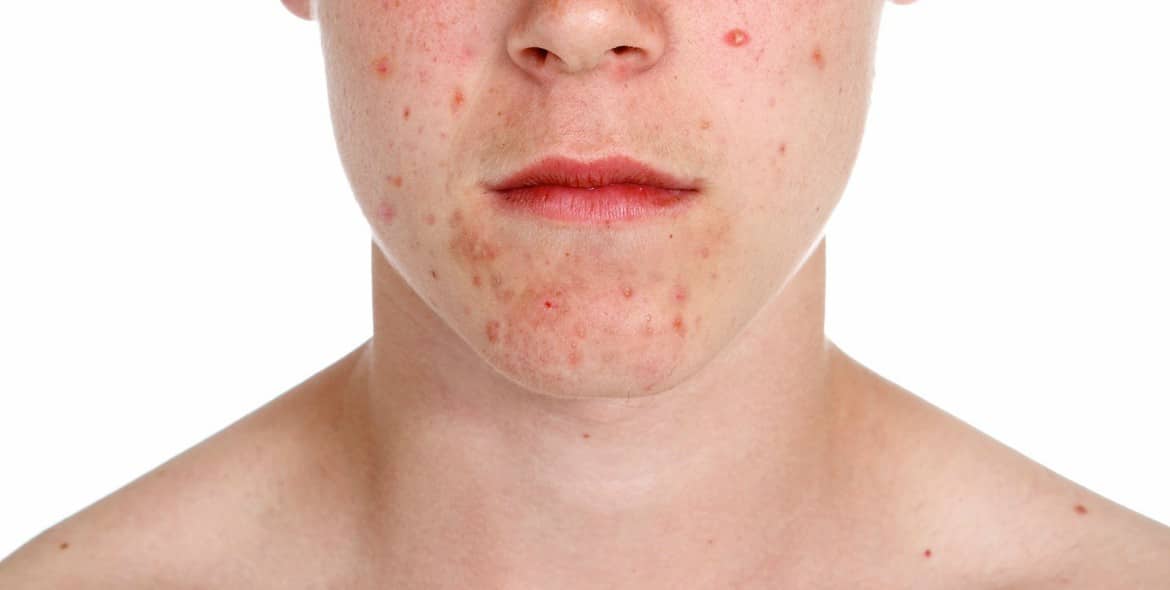 man-with-bad-skin-acne-healthy-skin