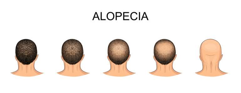 mens alopecia hair loss