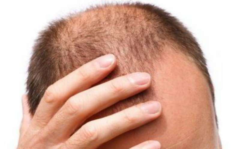 overall hair thinning men