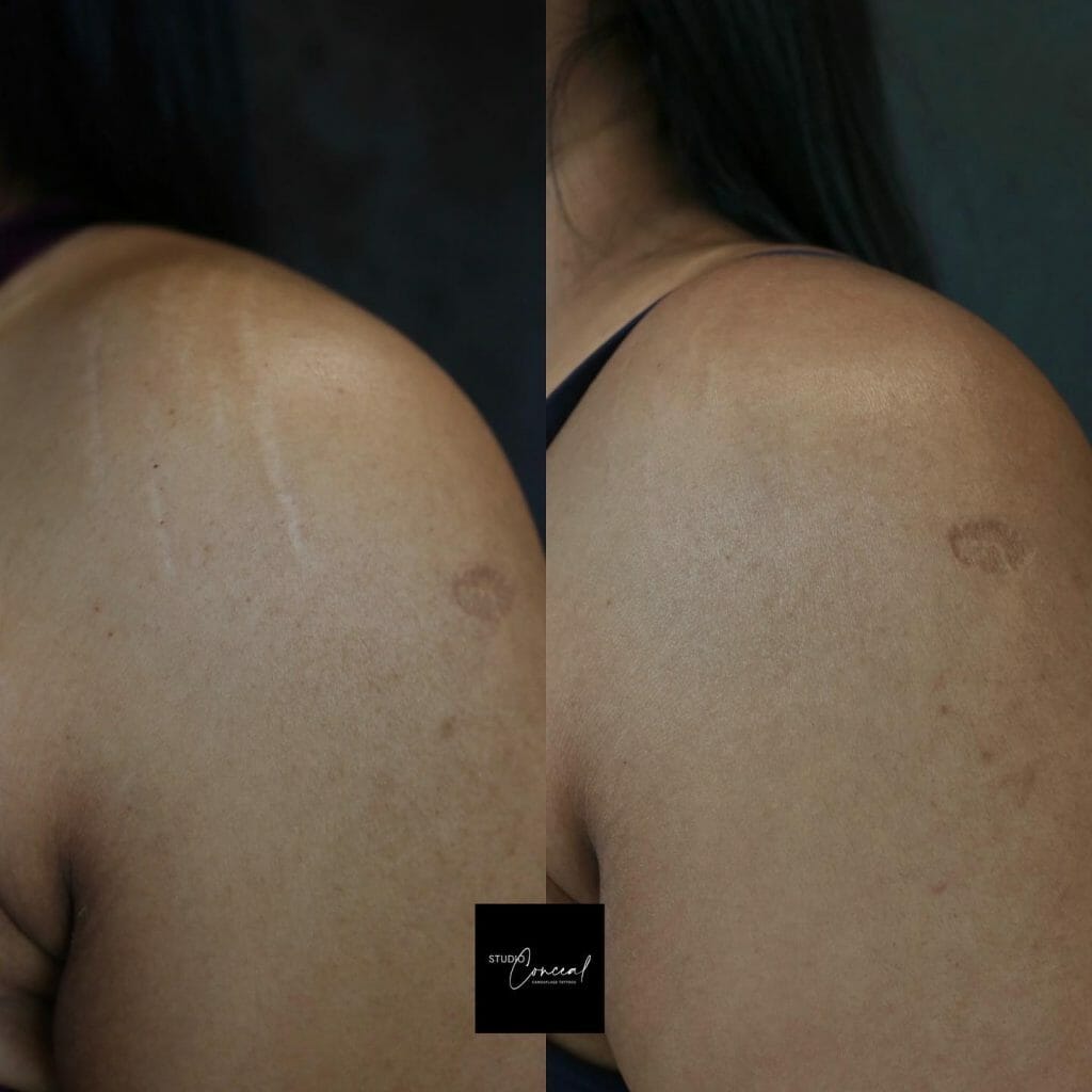 Skin Tone Tattoo Designs For Concealing Stretch Marks